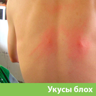 Укусы блох в Коломне