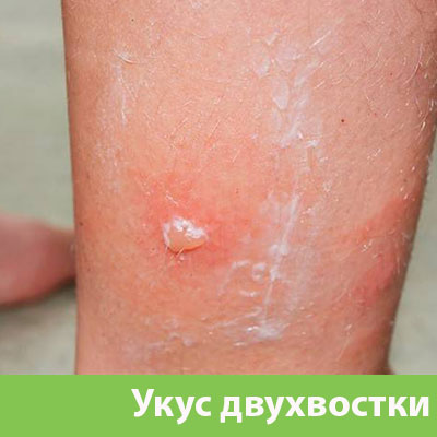 Укус двухвостки в Коломне