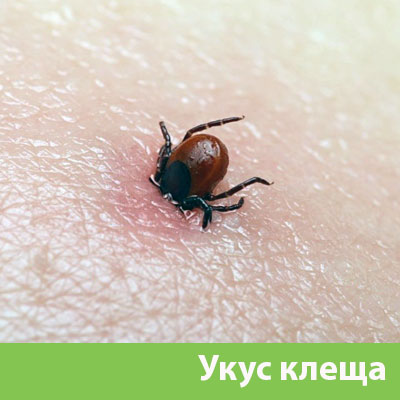 Укус клеща в Коломне
