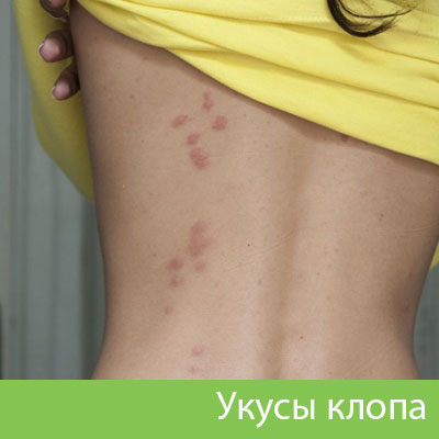Профессиональное уничтожение клопов в Коломне